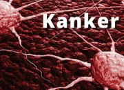 Kanker : Memahami Penyakit, Mengenali Gejala, dan Mencegah Penyakit Kanker!
