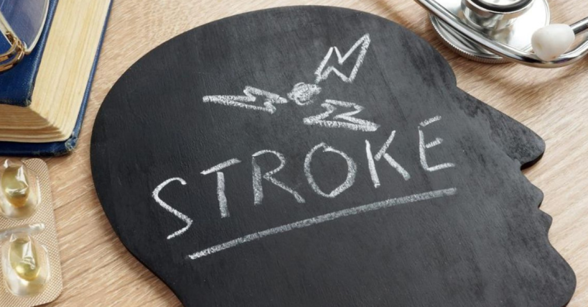 Senyum Mendadak Asimetris Bisa Jadi Tanda Awal Stroke, Kenali Gejalanya Sejak Dini