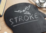 Senyum Mendadak Asimetris Bisa Jadi Tanda Awal Stroke, Kenali Gejalanya Sejak Dini